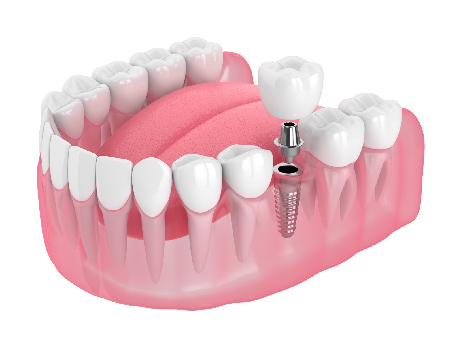 Dental Implant