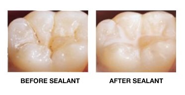 Sealant